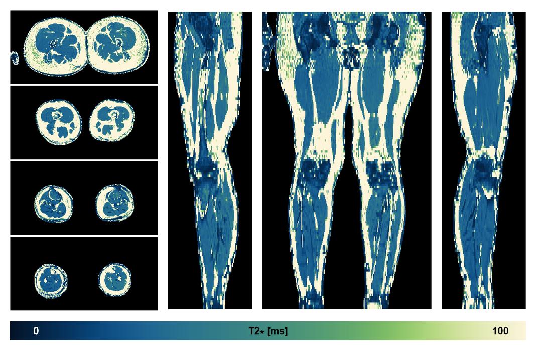 The T2 star relaxation time of the lower extremity obtained from the dixon reconstruction for muscle water fat quantification.